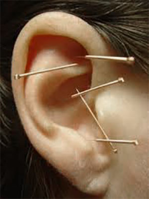 ear acupuncture