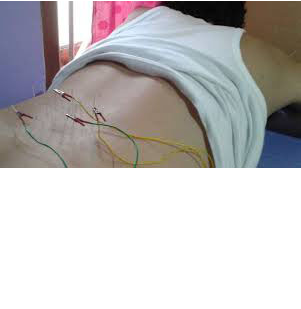 electro acupuncture